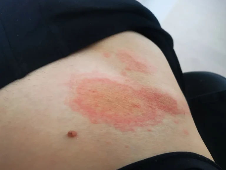 Hypersensitivity skin reaction