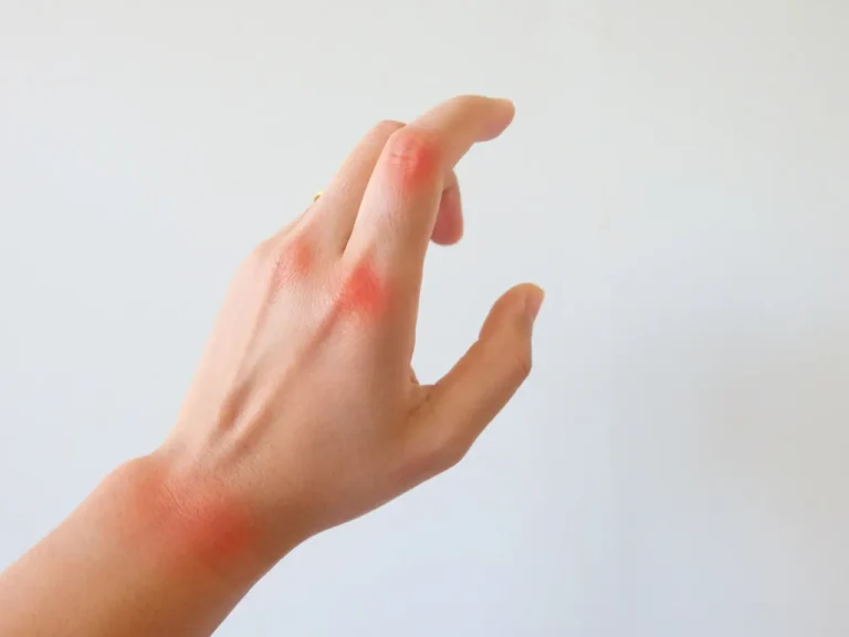 Rheumatoid Arthritis